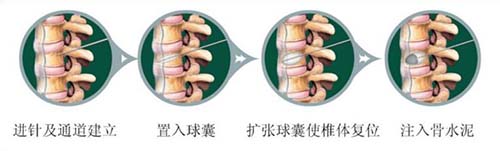 骨水泥套管組件注冊(cè)技術(shù)審查指導(dǎo)原則（2018年第107號(hào)）(圖1)